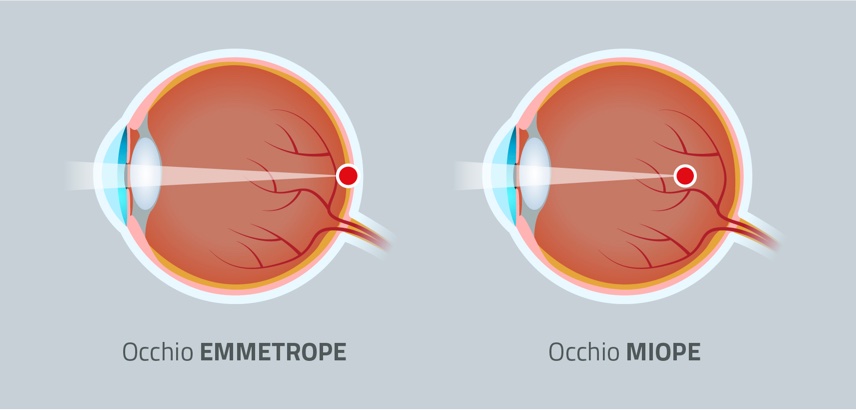 visione normale visione miope